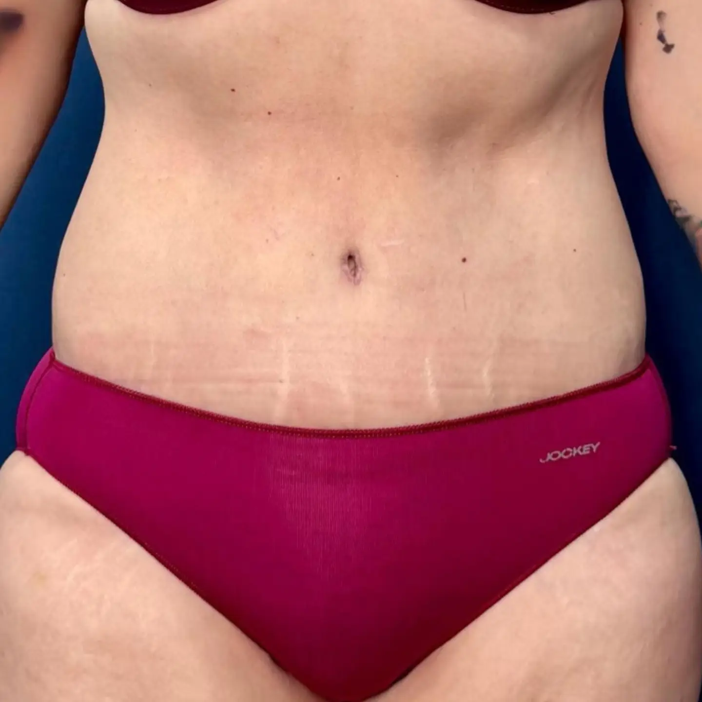 Abdominoplasty After